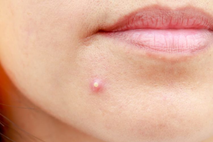 Đắp bột đậu xanh có hiệu quả trị mụn không?