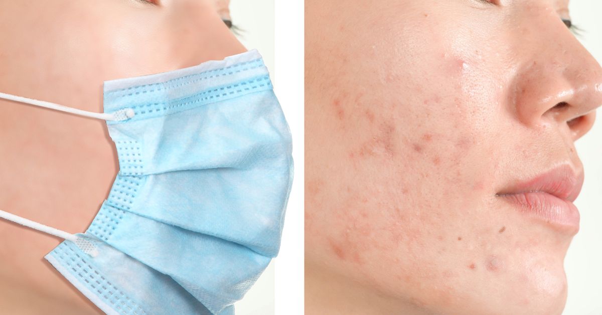 Mẹo và Cách ngăn ngừa mụn do đeo khẩu trang 
